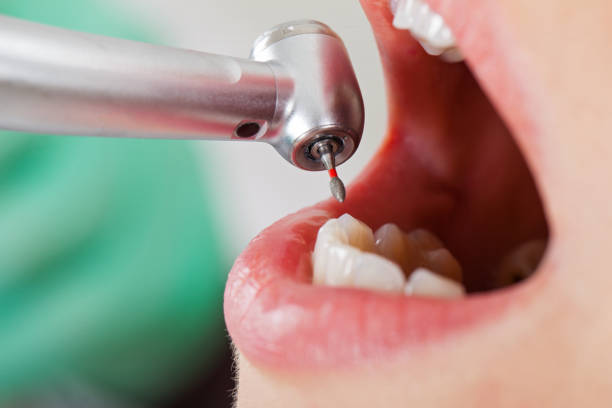 Best Emergency Dental Extractions in Washburn, ND